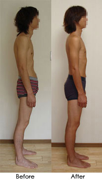 Rolfing - Before and After